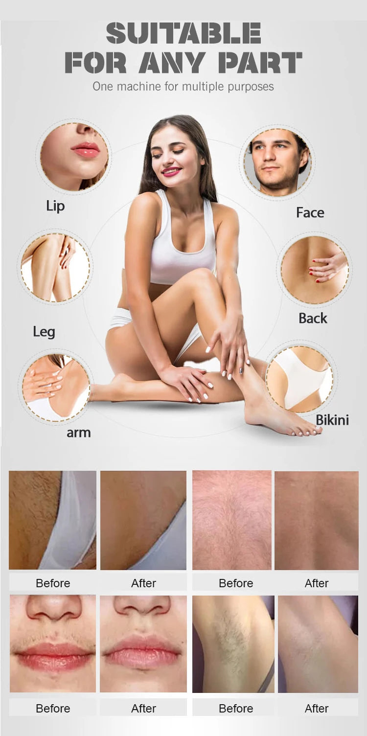 50,000,000 Shots Salon Professional Portable Painless 808nm1064nm755nm Diode Laser Hair Removal Machine with Triple  Wavelength