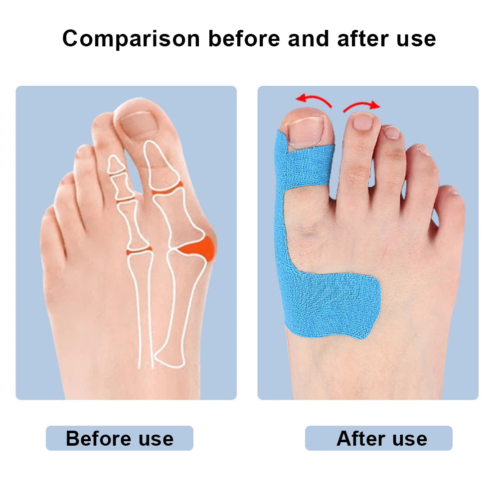 10Pcs Bunion Corrector Bunion Straightener Breathable Orthopedic Bunion Strap Self Adhesive Toe Separator for Big Toe Correction