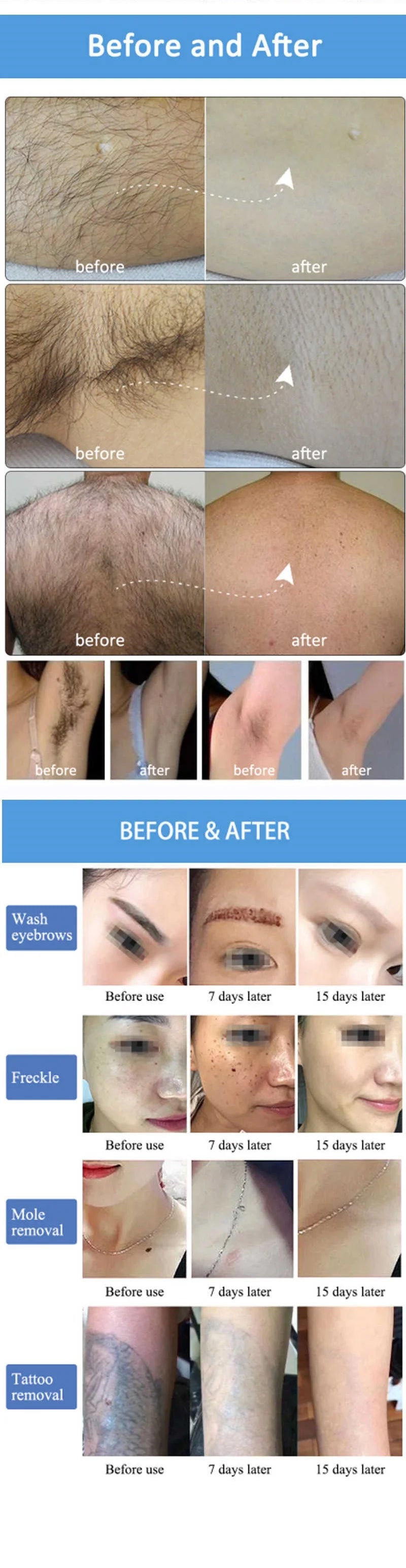 Professional Diode Ice Titanium Laser Hair Removal Machine Portable 808 755 1064 Alexandrite Device 3 Waveleng Permanent Removal