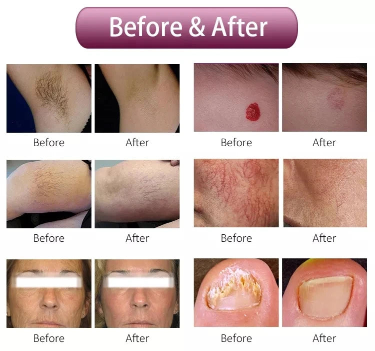 2026 SLyriclaser 1064/532nm long pulse width High quality 1064nm painless hair removal Clinic 755NM alexandrite machine