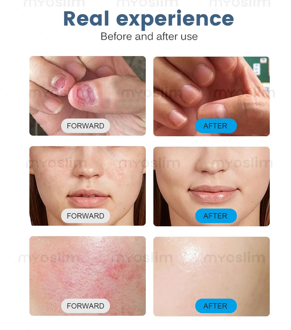 BEST 30W 5 in 1 980nm Diode Laser Vascular Removal Machine Remove Spider Veins 980 Diode Laser Blood Vessels Removal Nail Fungus