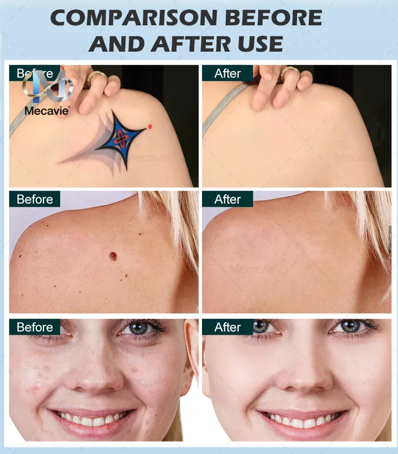 Newest 2 in 1 Multifunction Epilation Diode Laser Hair Removal Machine Pico laser Nd Yag tattoo removal machine Carbon Peeling